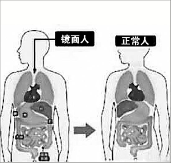 男子五脏六腑都反着长 为其做手术就像脑筋急转弯